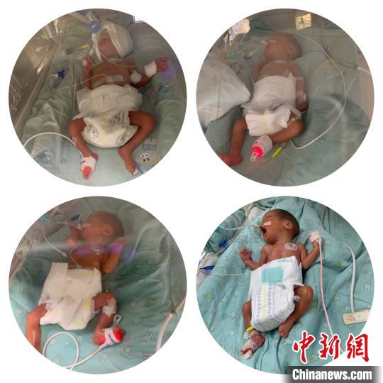 四胞胎宝宝们正在克服呼吸、喂养、感染、大脏器发育的成熟度等难关。徐敬供图